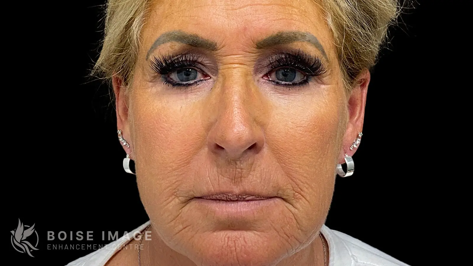 Lower Face Filler After