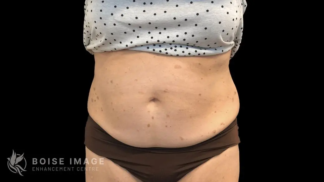 Abdomen After