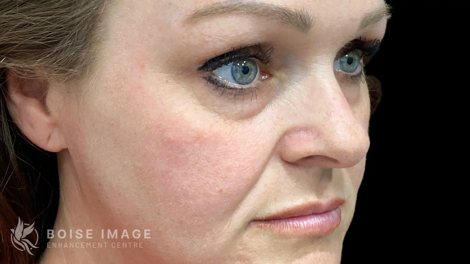 Under Eyes Before