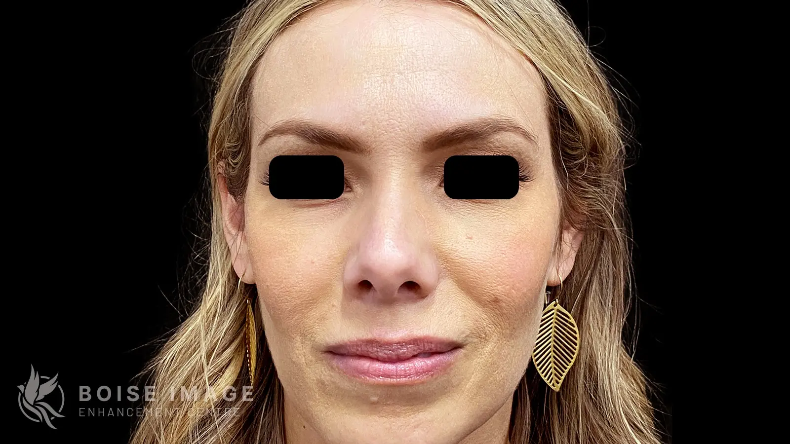Cheeks and Under Eyes After