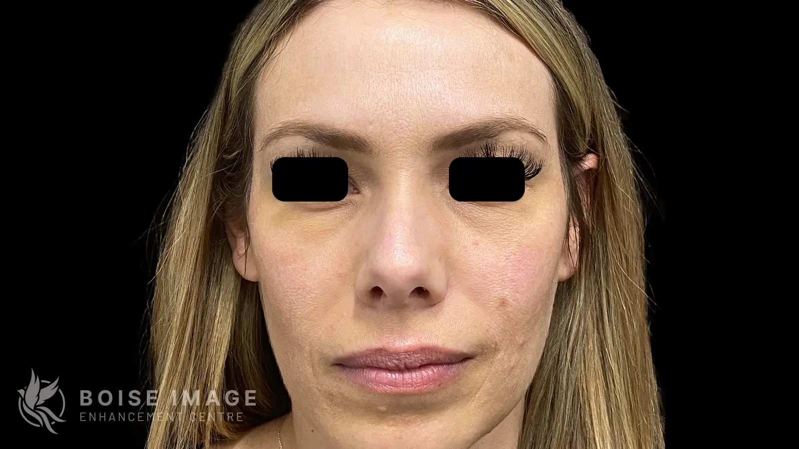 Cheeks and Under Eyes Before