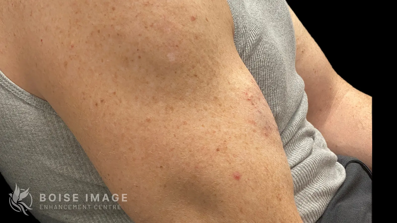 Left Bicep Before