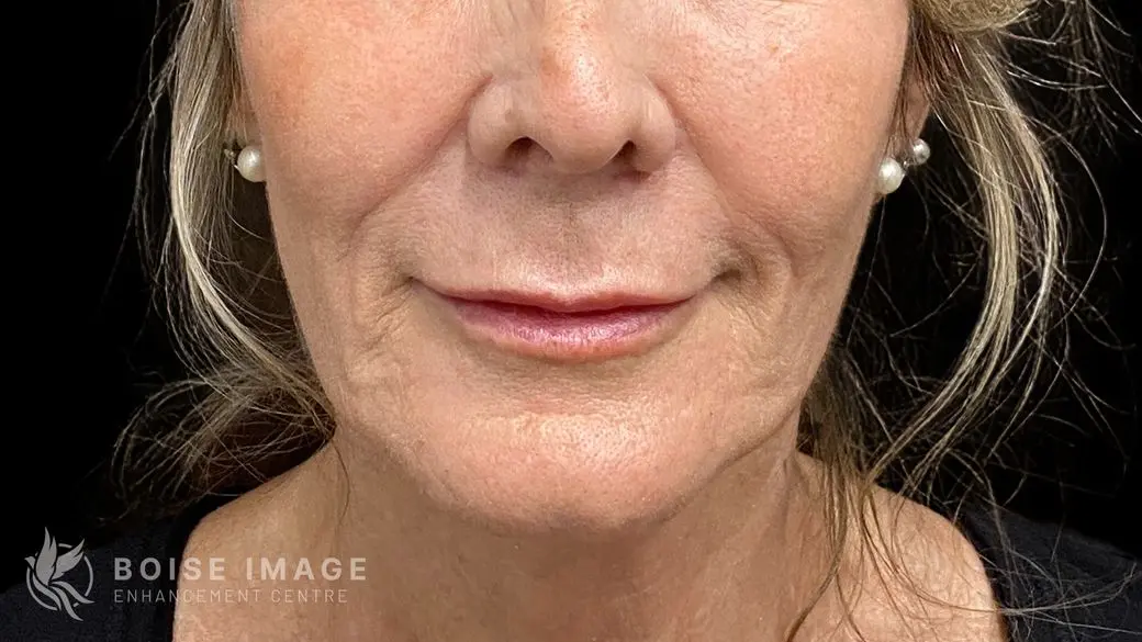 Lips After