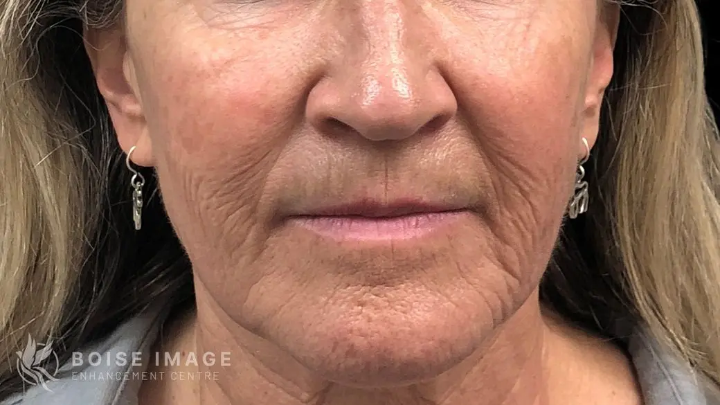 Lower Face Before