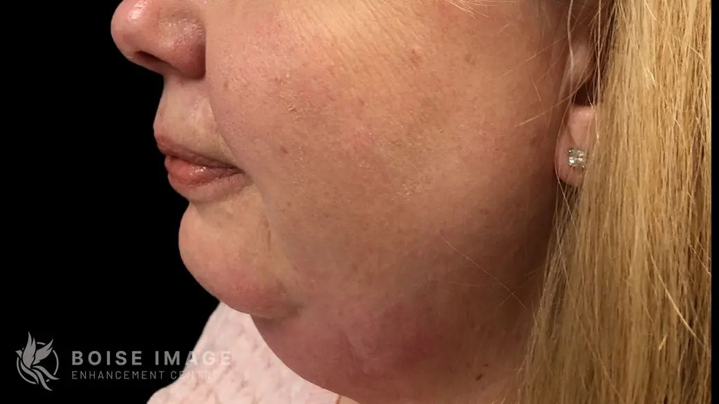 Kybella Before