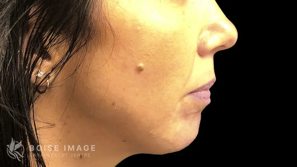 Chin After