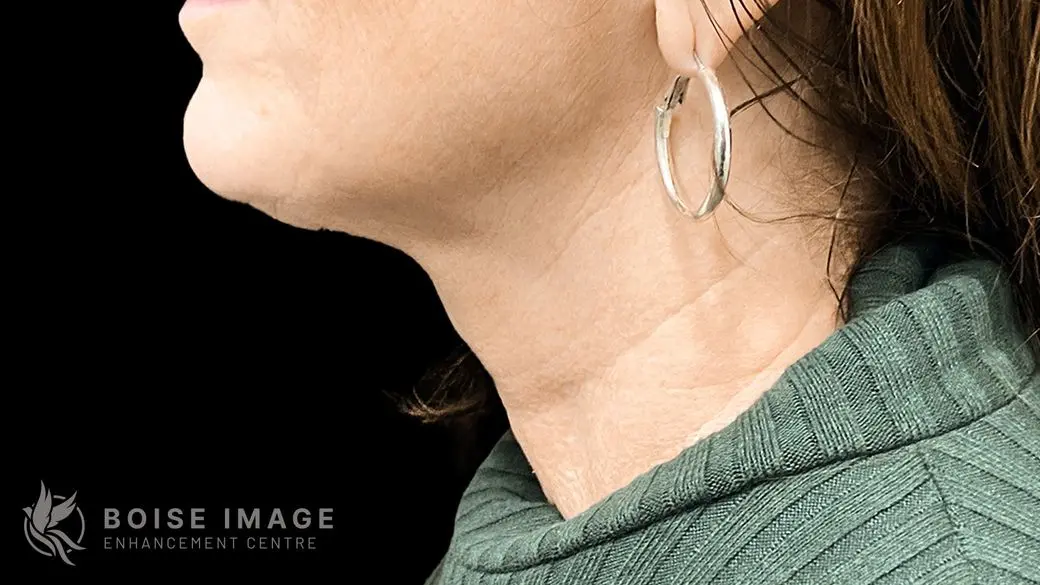 Neck Before