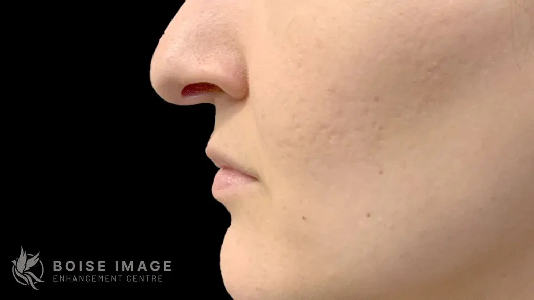 Lower Face Before