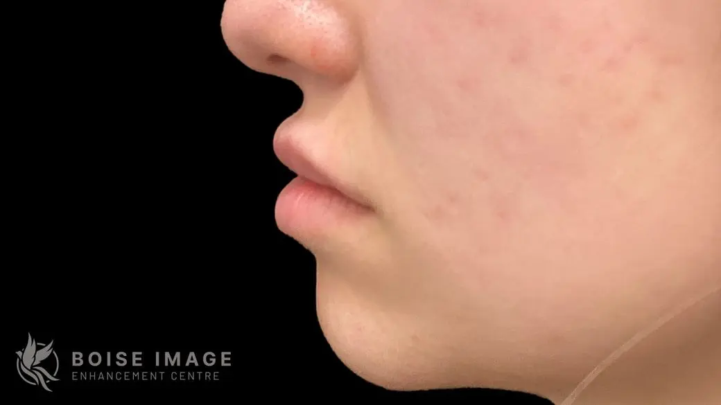 Lips After