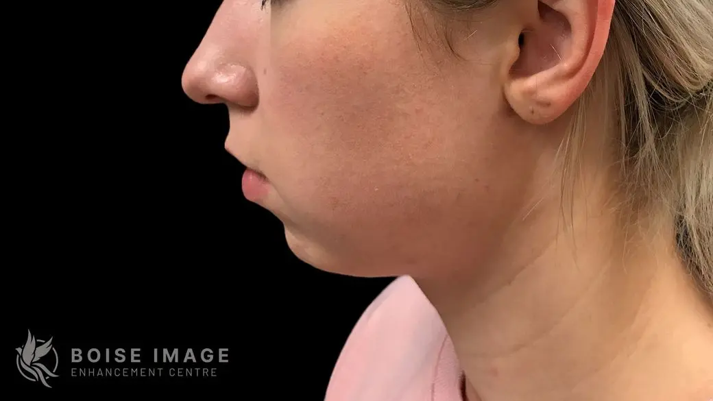 Kybella Before