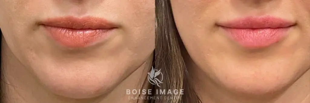 Restylane Kiss Before & After Picture