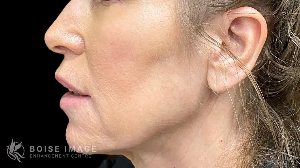 Lower Face Before
