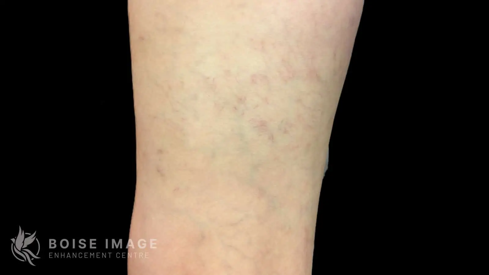 Anterior Thigh Before