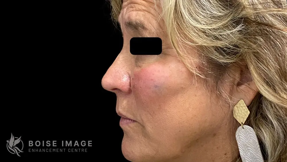 Light Lift After