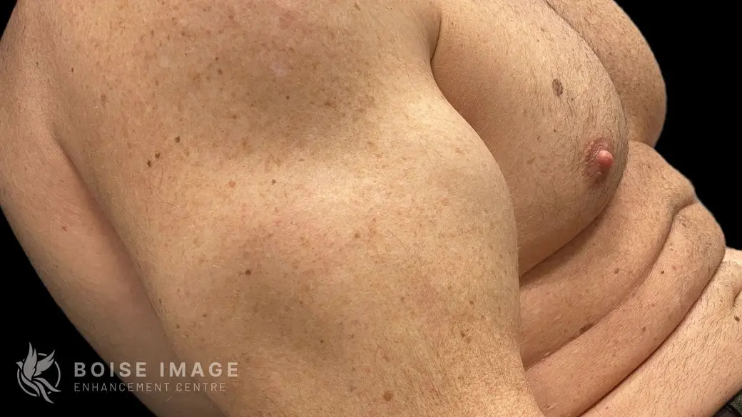 Left Bicep After