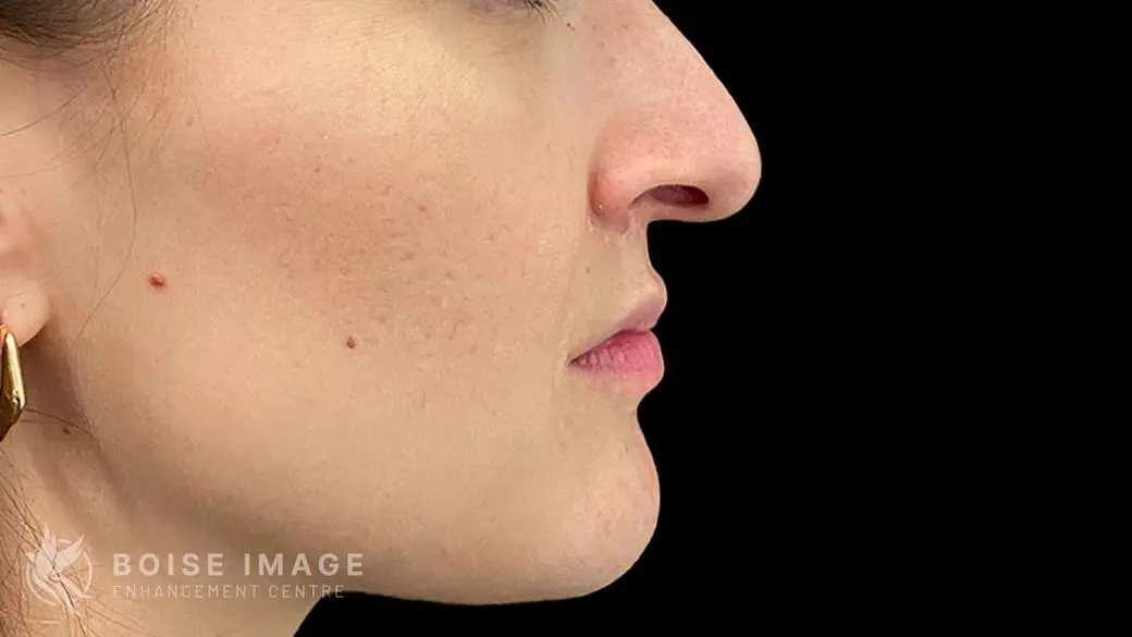 Lower Face After