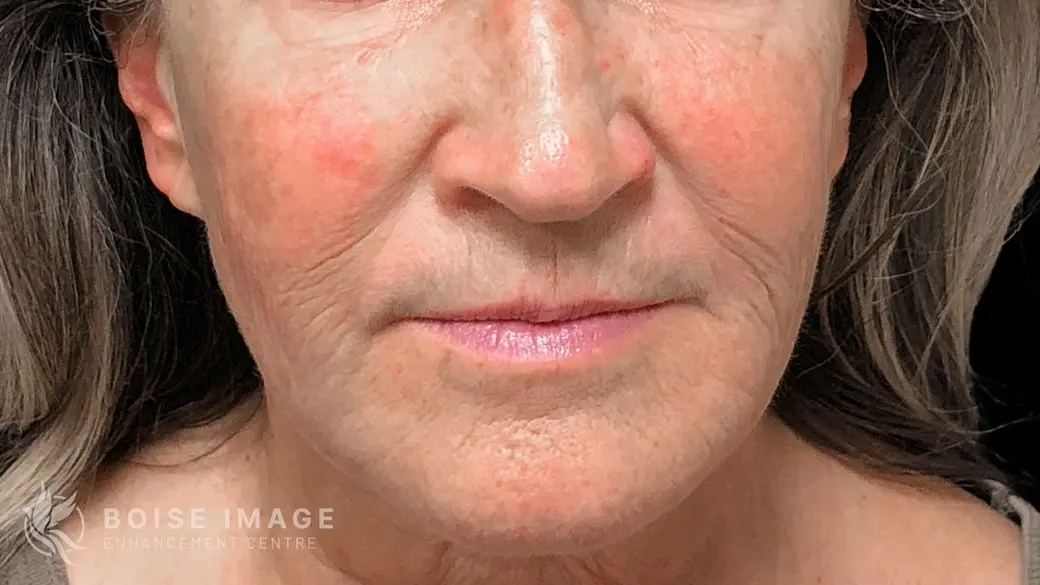 Lower Face After