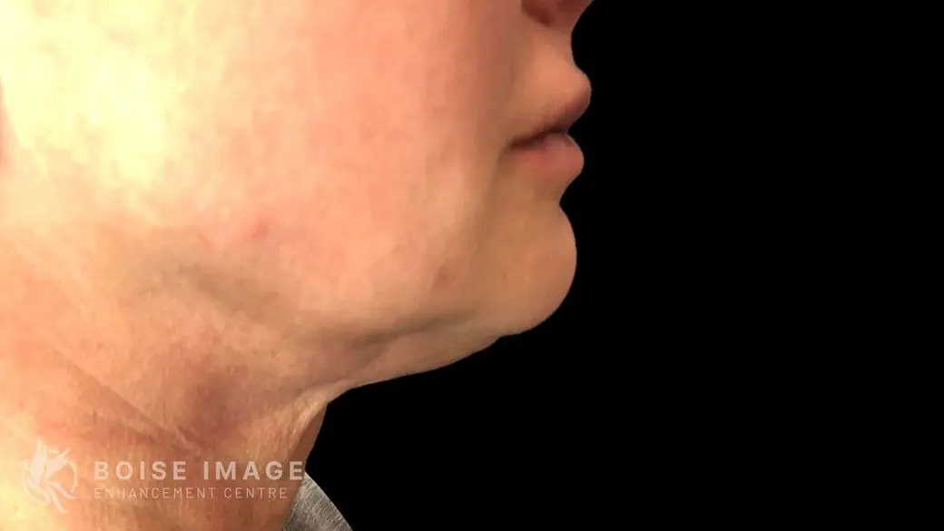 Lower Face Before