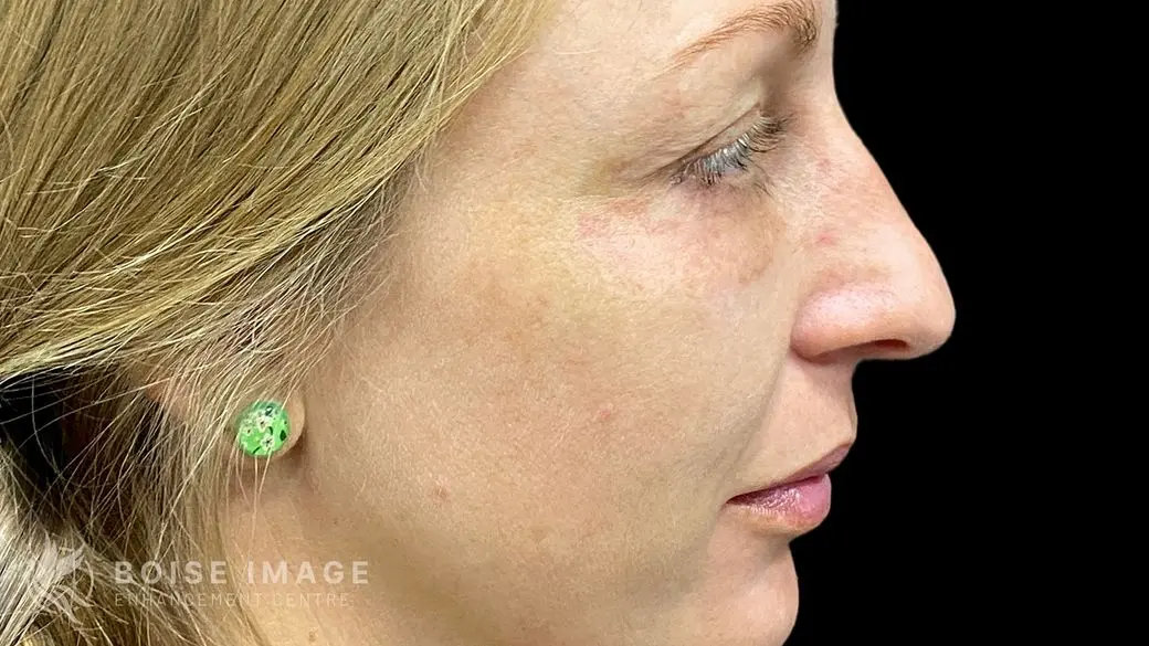 Facial Balancing Side Before