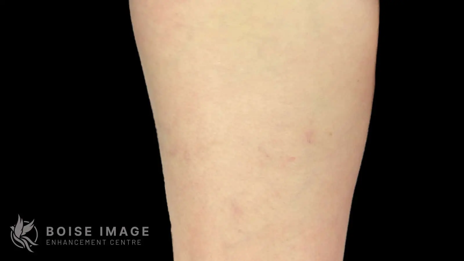 Anterior Thigh After