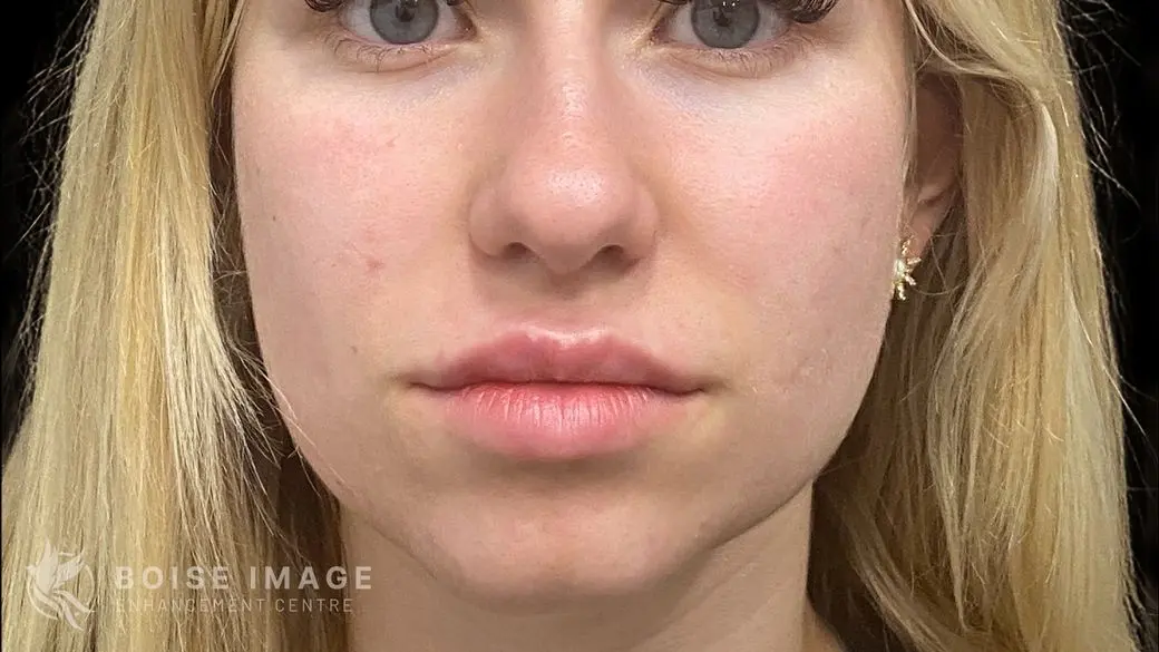 Lips After