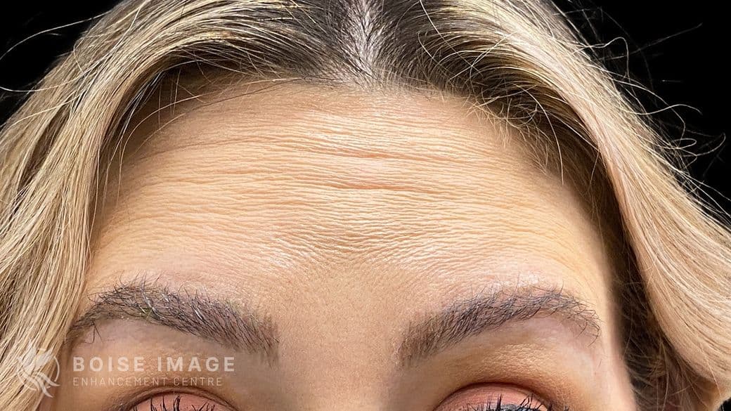 Forehead Before
