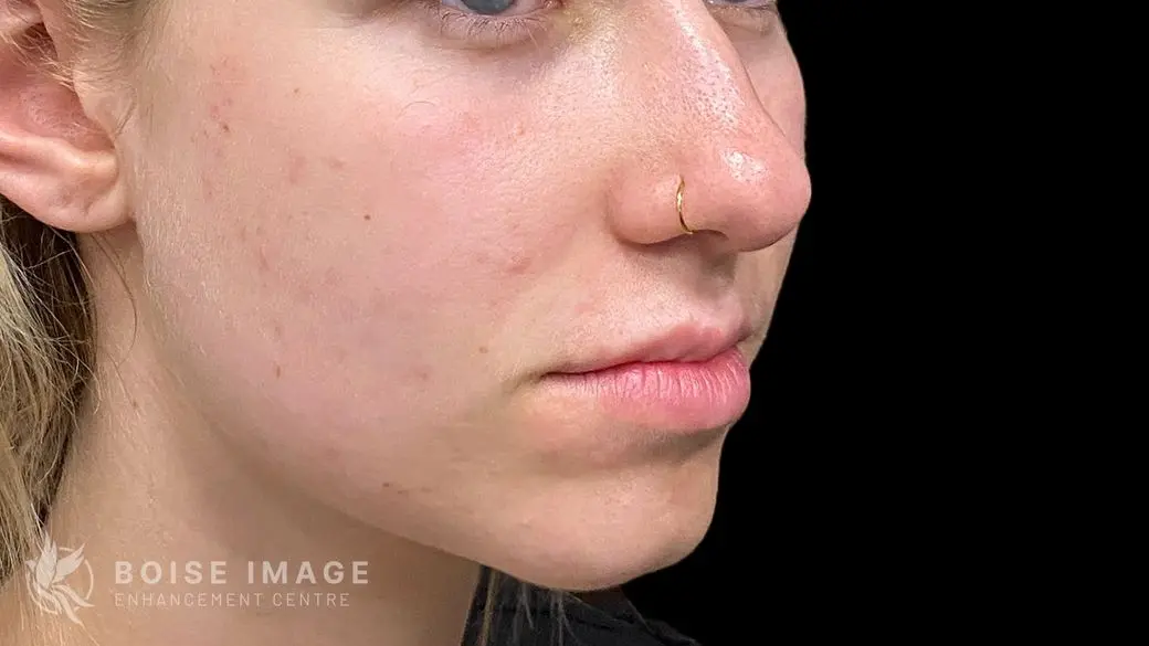 Lips Before