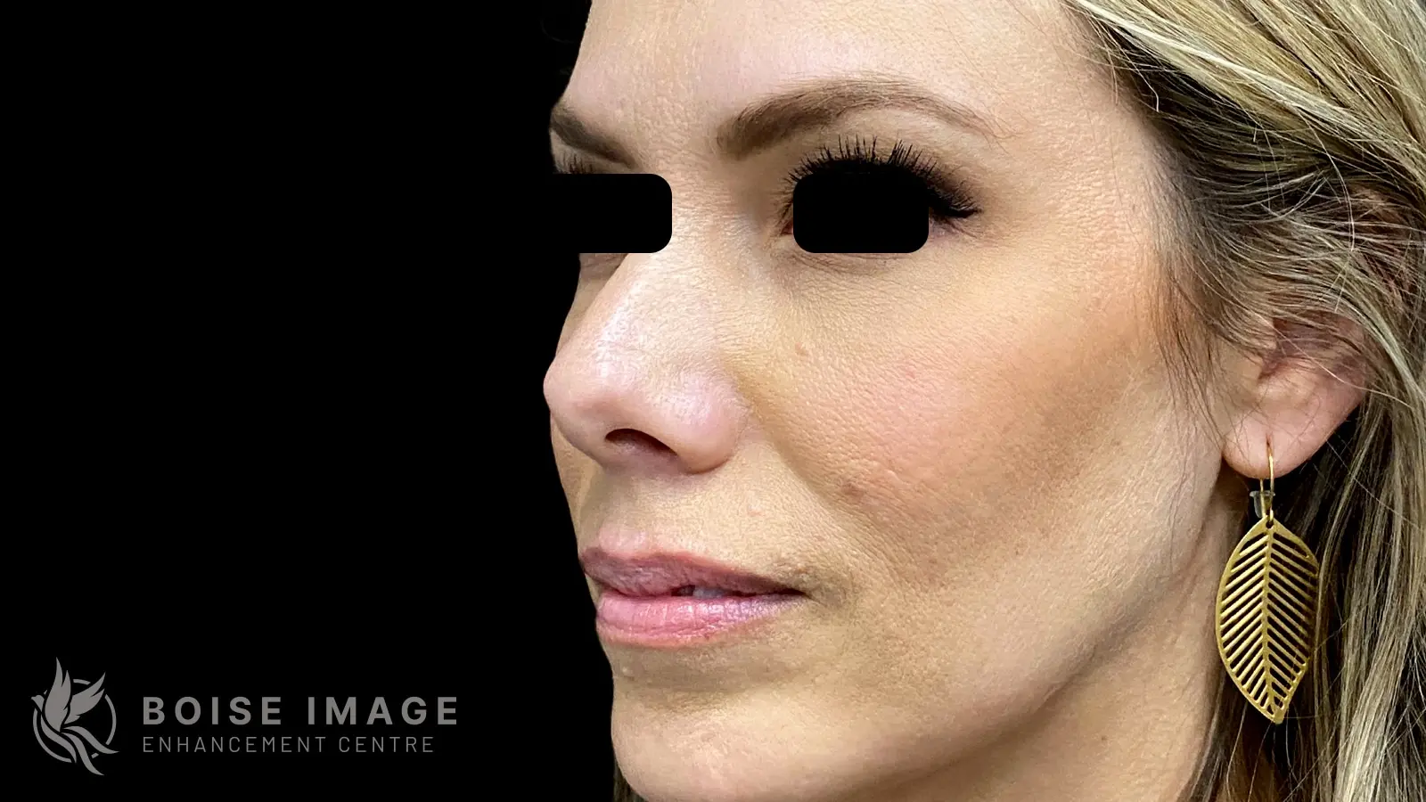Cheeks and Under Eyes After