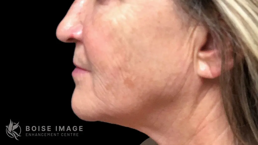 Lower Face After