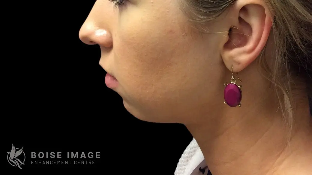 Kybella After