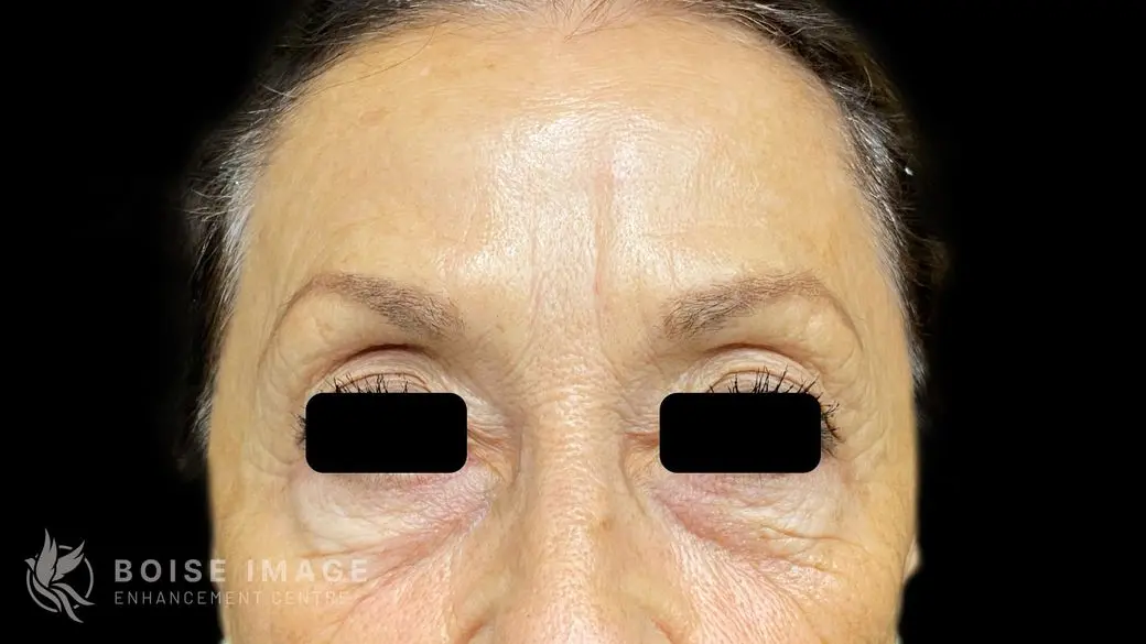 Glabella After