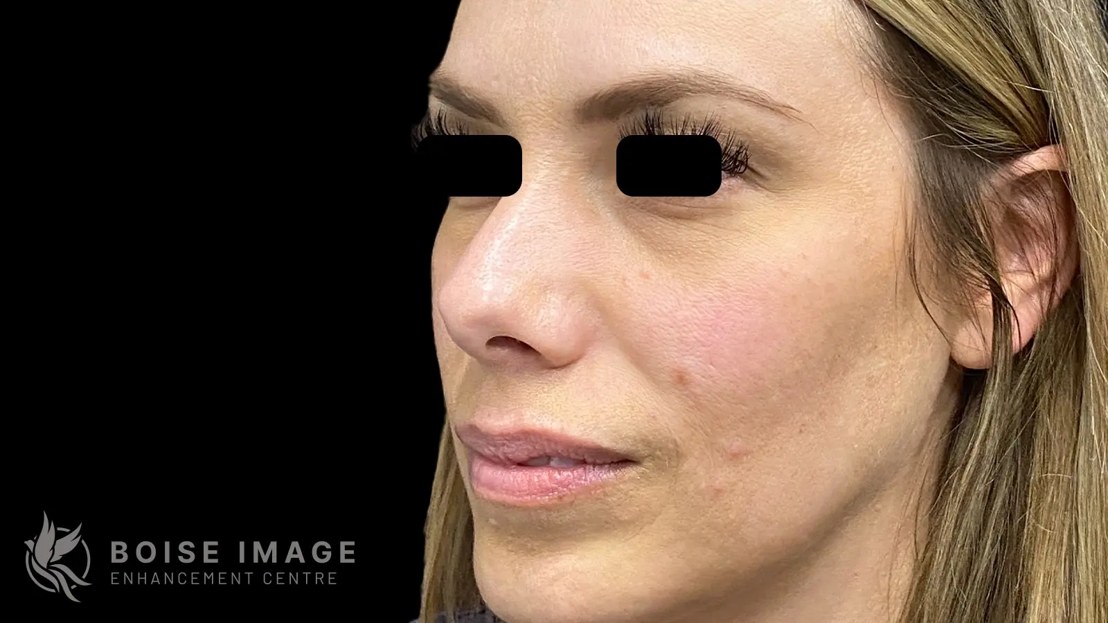 Cheeks and Under Eyes Before