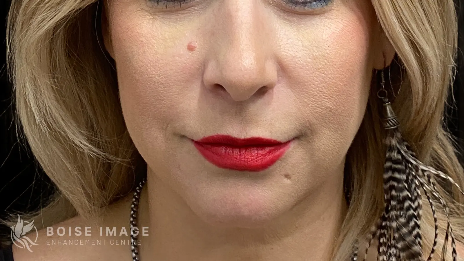 Cheeks After