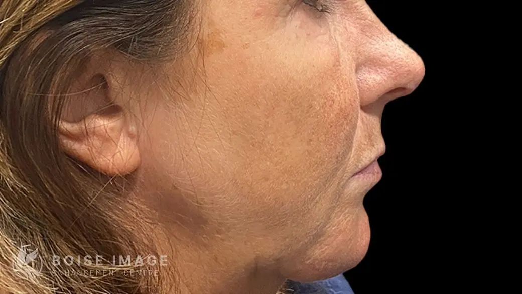 Lower Face Before