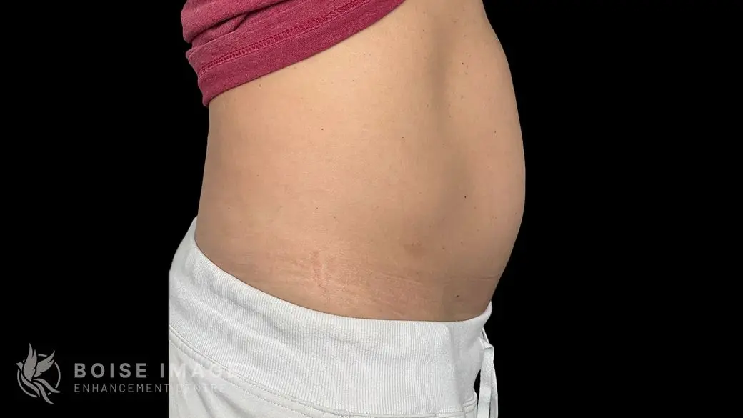 Abdomen After