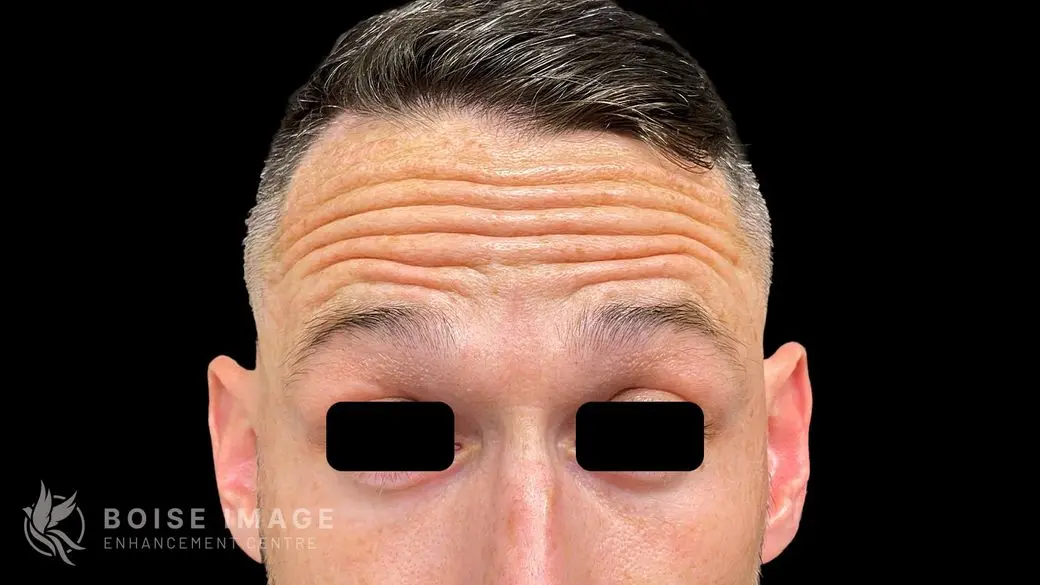 Forehead Before