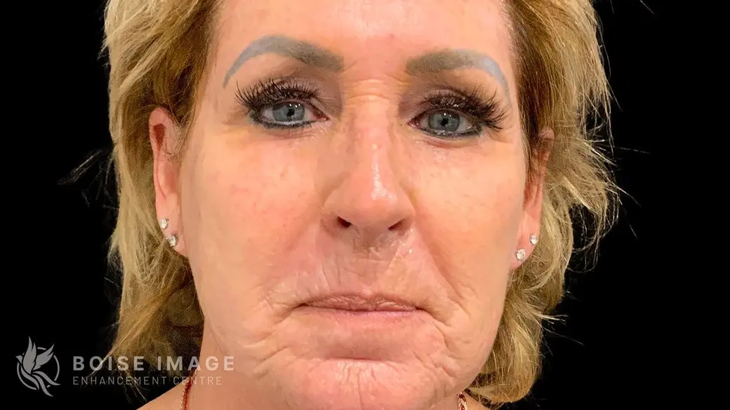 Lower Face Filler Before