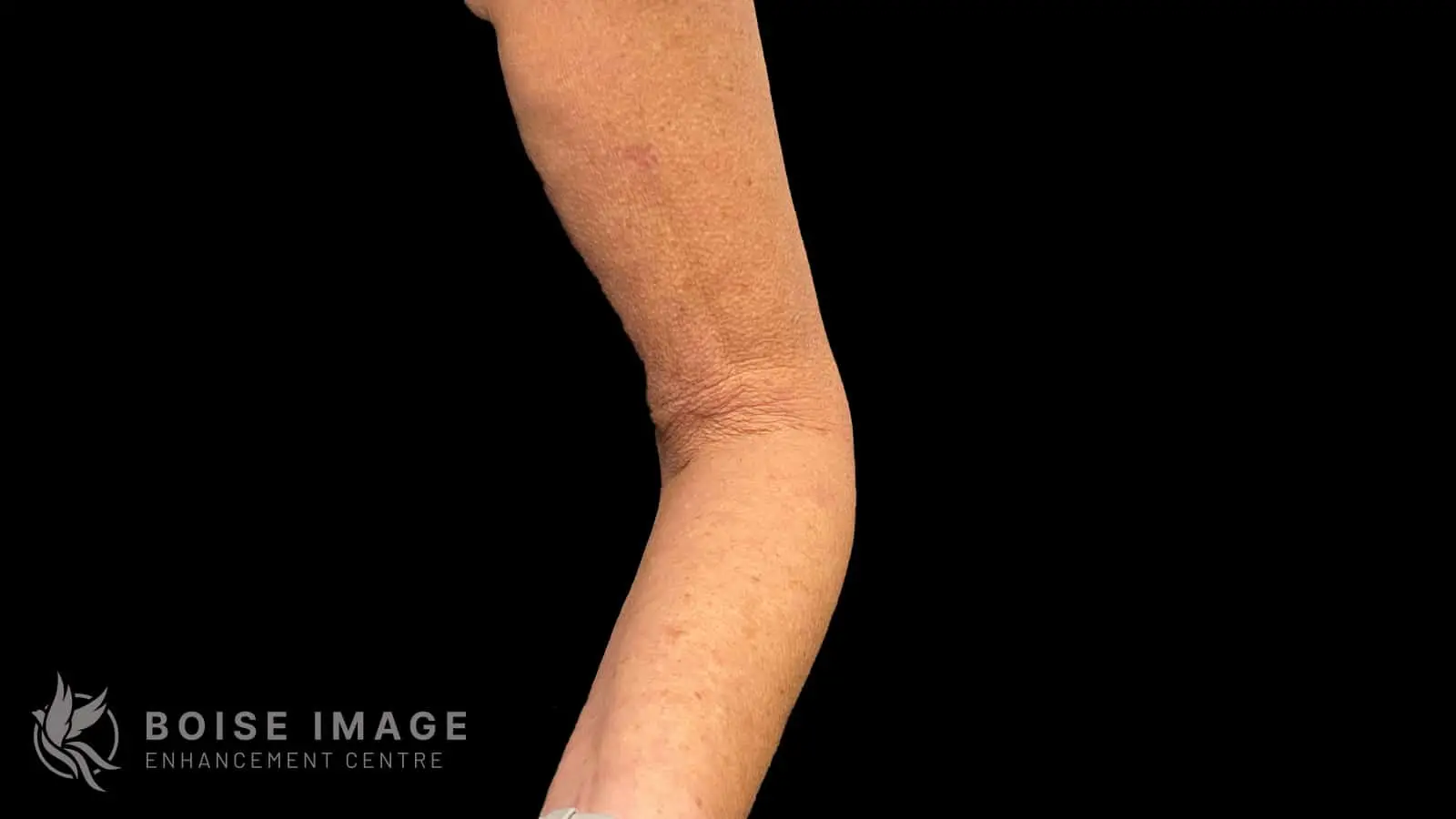 Left Arm After
