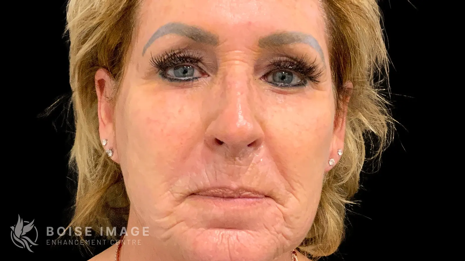 Lower Face Filler Before