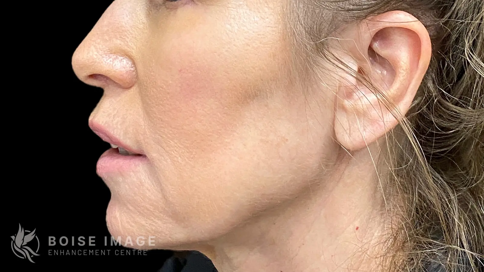 Lower Face Before
