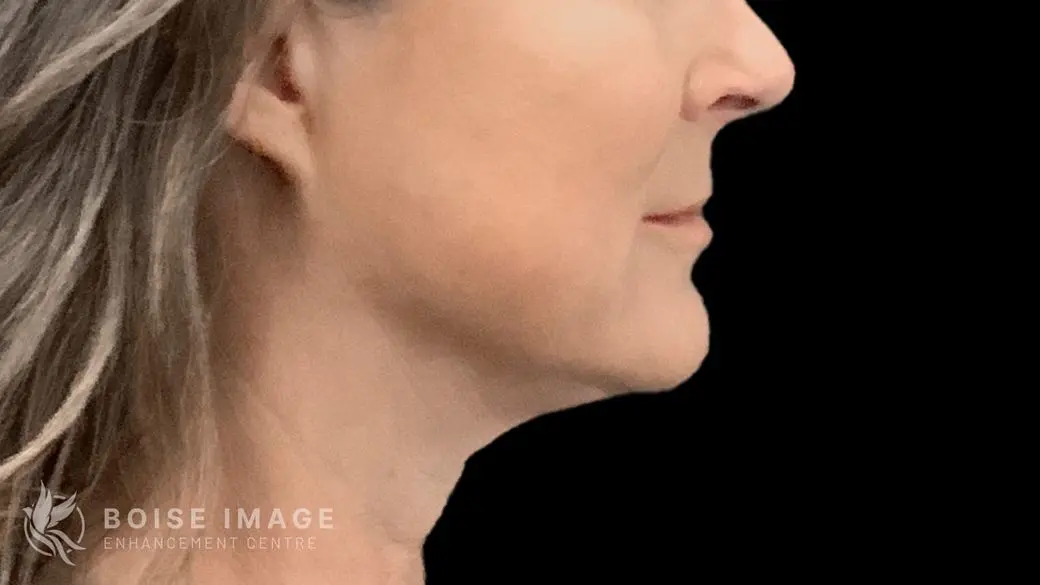 Jawline Chin After