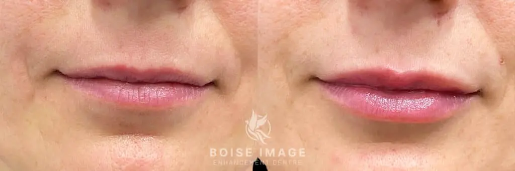 Restylane Silk Lip Filler Before and After Photo