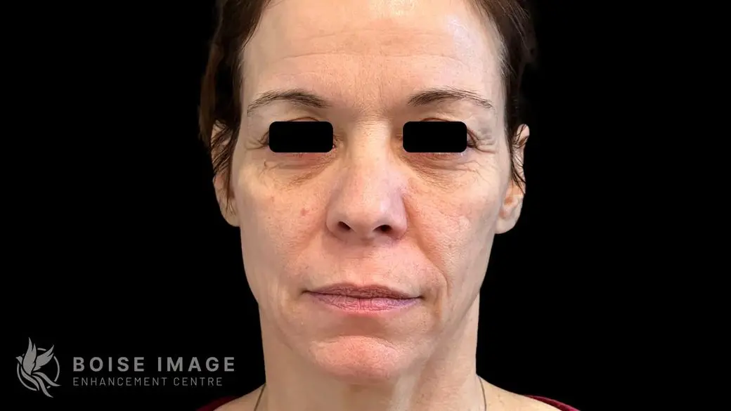 Full Face Before