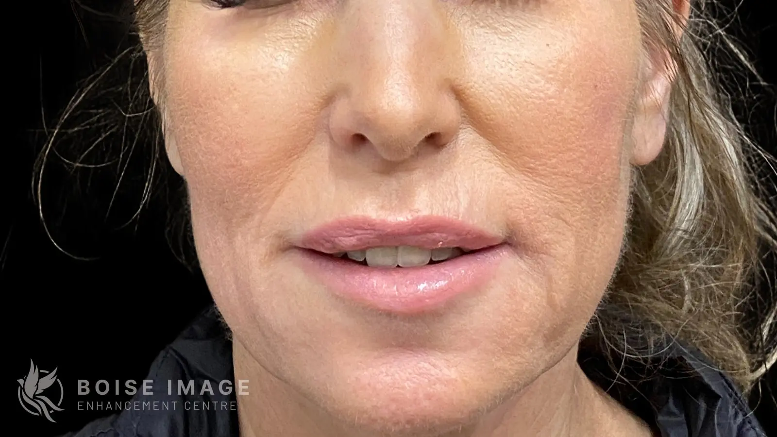 Lower Face Before