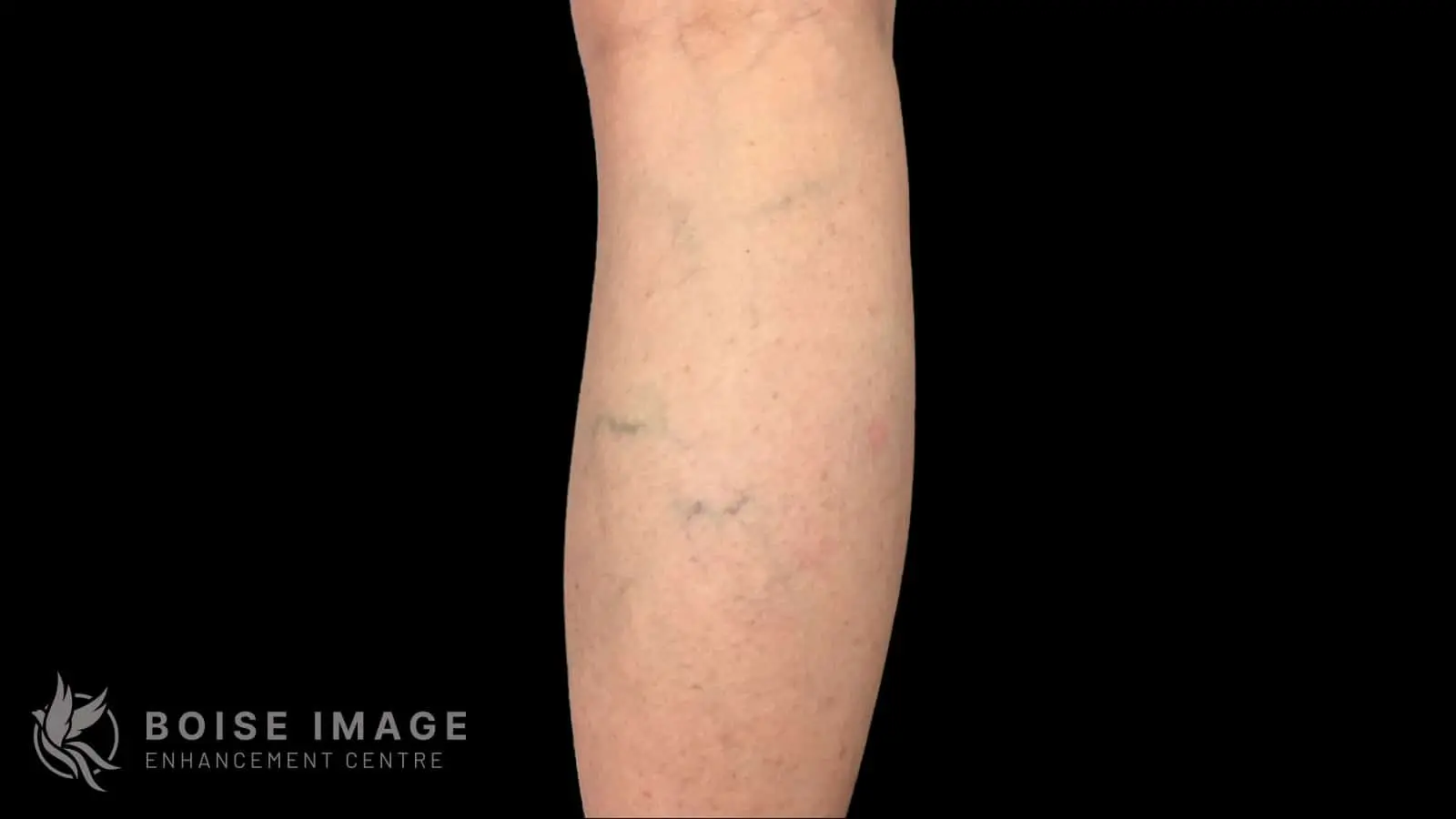Anterior Thigh Before