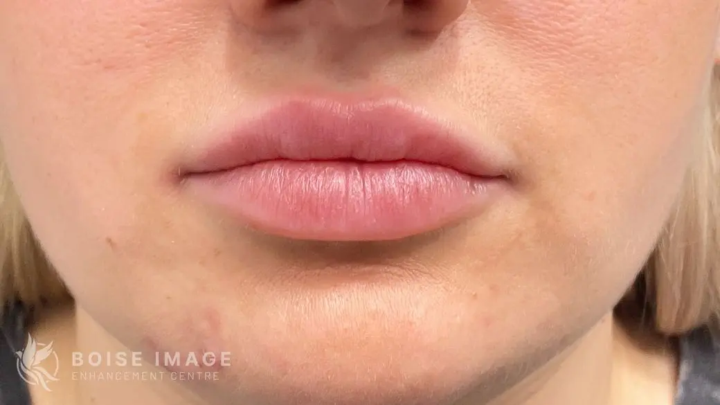 Lips After
