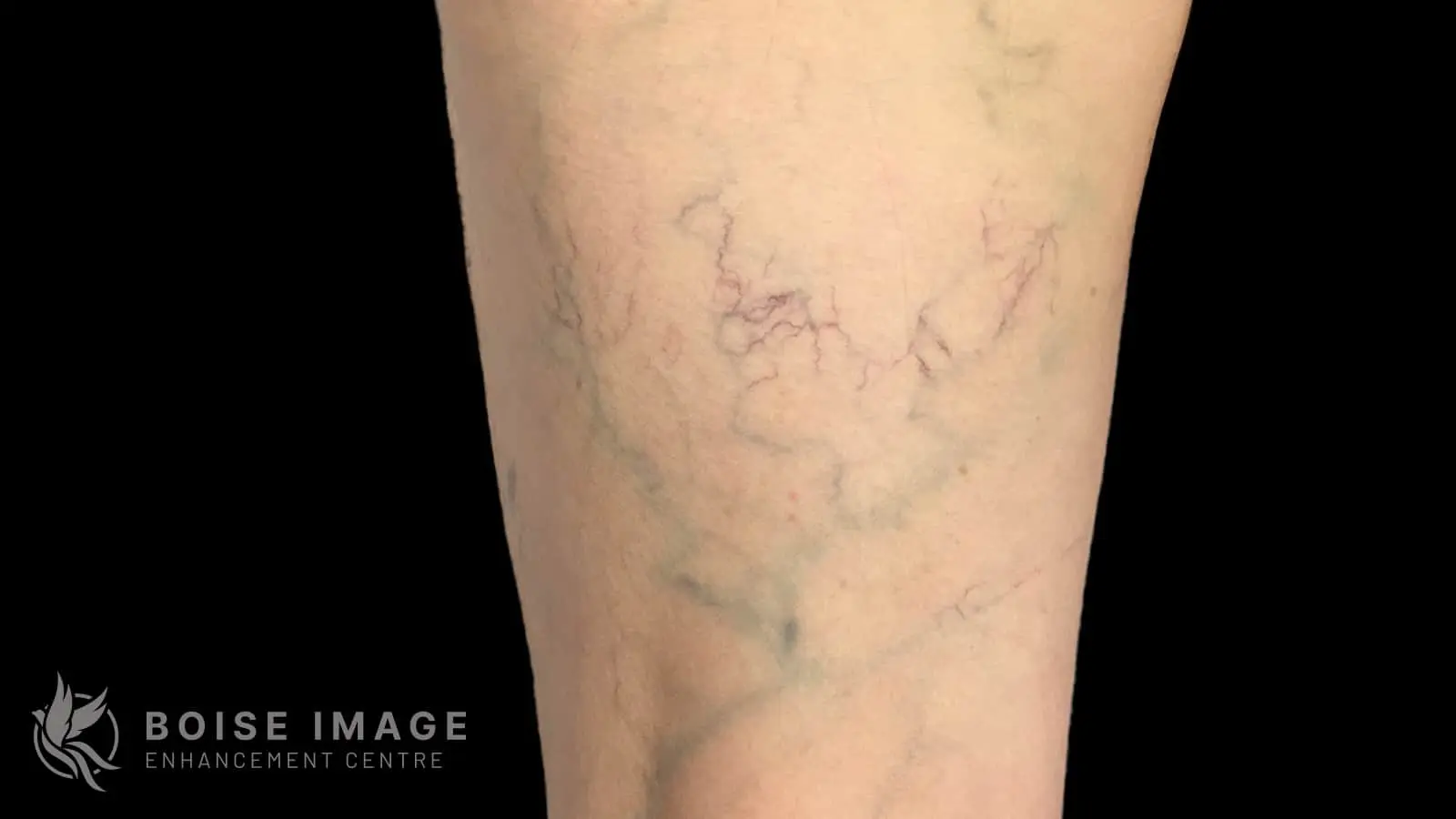 Anterior Thigh Before