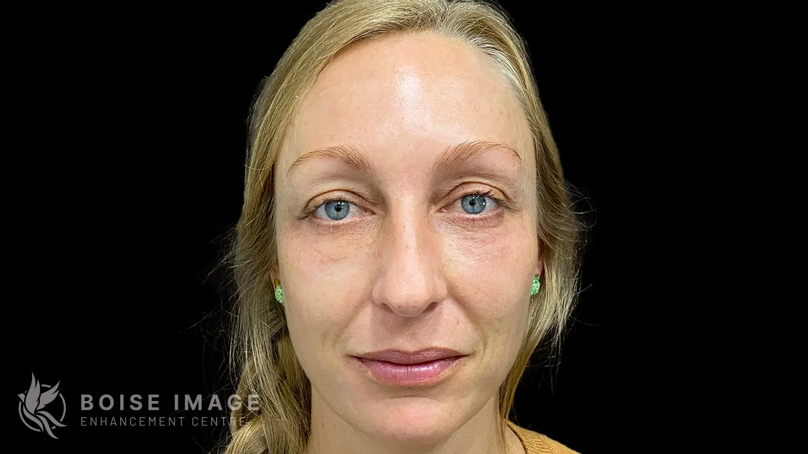 Facial Balancing Front Before