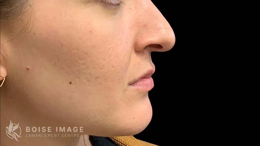 Lower Face Before
