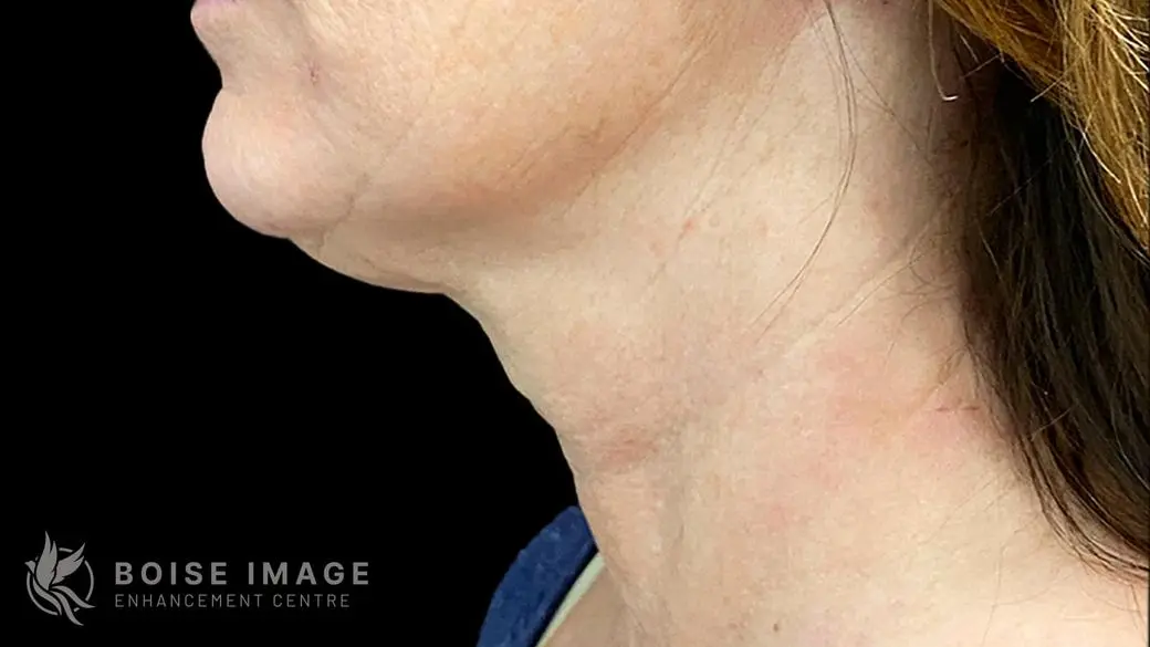 Neck After